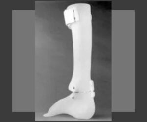 A medical prosthetic leg designed for below-knee amputation.